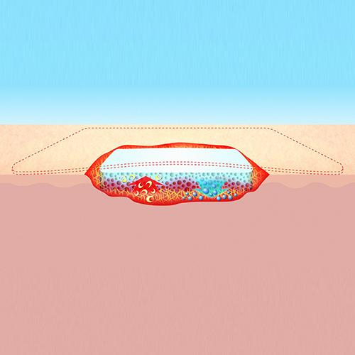 Yara Granülasyon Evresi