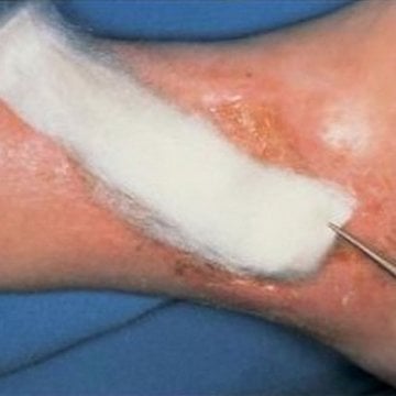 Suprasorb A Kalsiyum Aljinat Yara Örtüsü