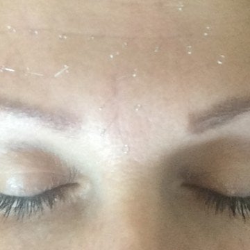 İntradermal İğne 0.18 x 7 mm, 200 Adet