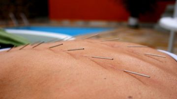 SMC Çelik Akupunktur İğnesi Kuru İğne