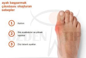 Hallux Valgus Bunyon Koruyucu